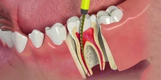 آیا در روت کانال، اعصاب دندان را از بین می‌روند؟