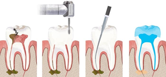 درمان ریشه دندان چگونه است؟