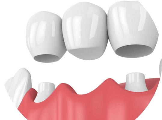 روش غیر مستقیم ترمیم دندان