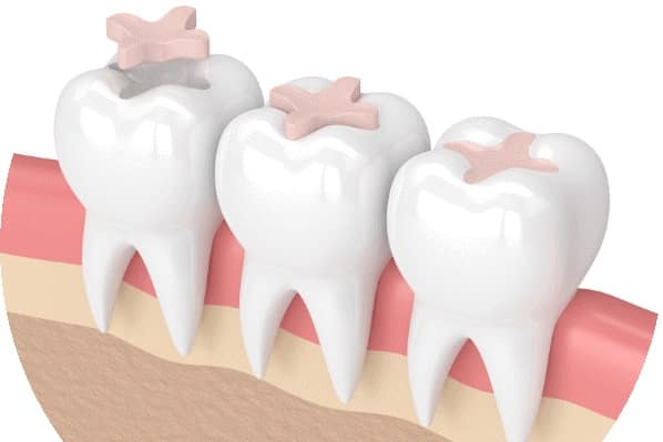 روش مستقیم ترمیم دندان