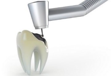 چرا پر کردن دندان ضروری می‌باشد؟