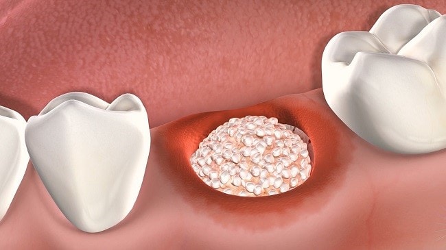 dental-bone-graft-recovery-and-healing-stages-pain-and-swelling