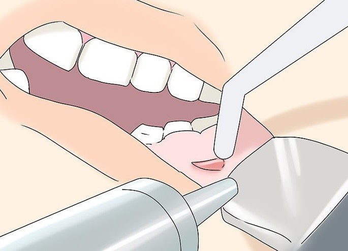 how to drain a gum abscess home remedies