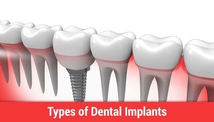 types of dental implants