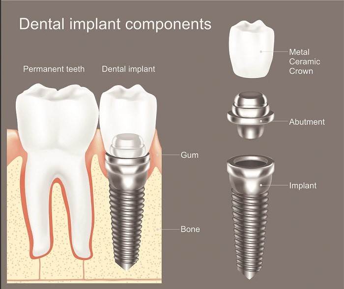 types of dental implants