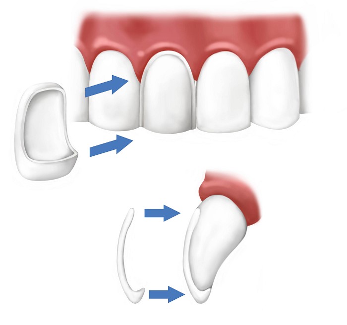 Advantages of laminate dentistry