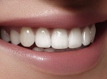 انواع لمینت دندان برای مرتب کردن دندان کدام لمینت بهتر است؟