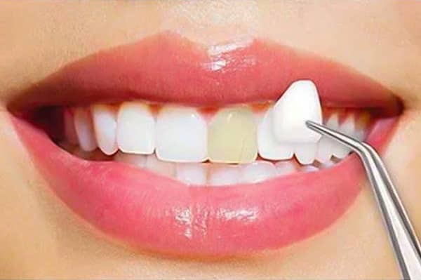 روند انجام ونیر پرسلن دندان