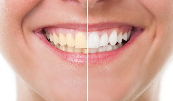 سفید کردن دندان از بین بردن لکه های زرد و بدرنگ روی دندان (بلیچ)