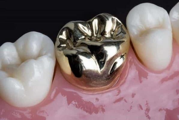 تاج دندان فلز