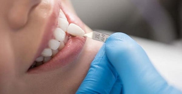 لامینیت دندان ظاهر طبیعی دارد