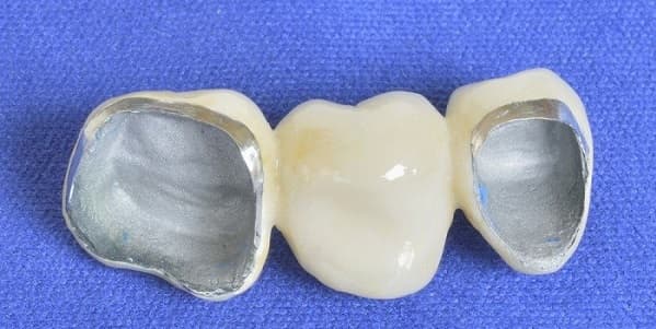 تاج دندان پرسلن فیوز شده با فلز